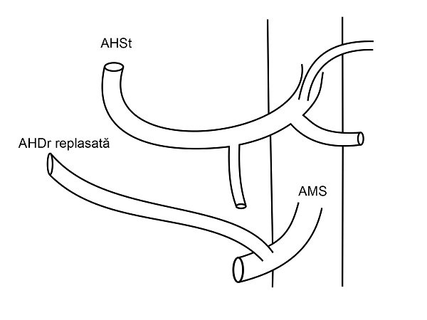 Anatomia arteriala hepatica tip III