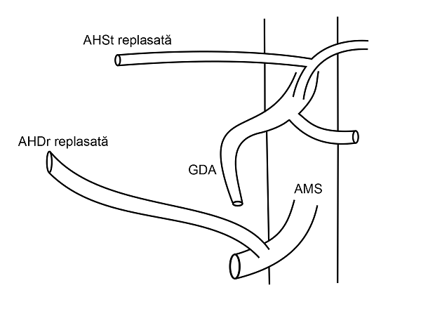 Anatomia arteriala hepatica tip IV